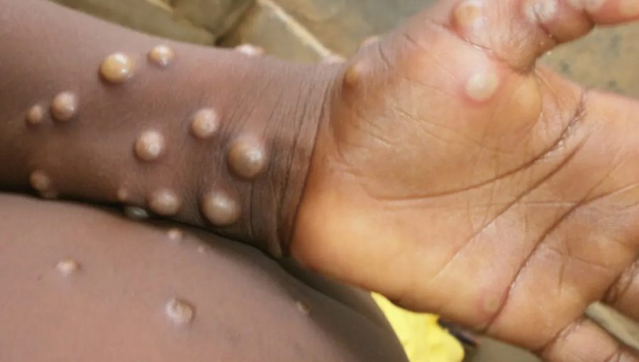 Around 80 monkeypox cases have been confirmed. Source: NDTV.