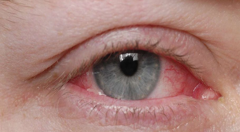 After Karachi, pink eye infection spreads in Lahore