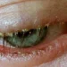 Lice in Eyelashes